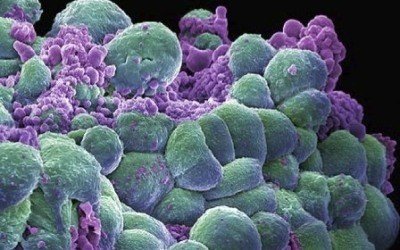 Rakovinové bunky ktoré už značne oslabili ľudský organizmus